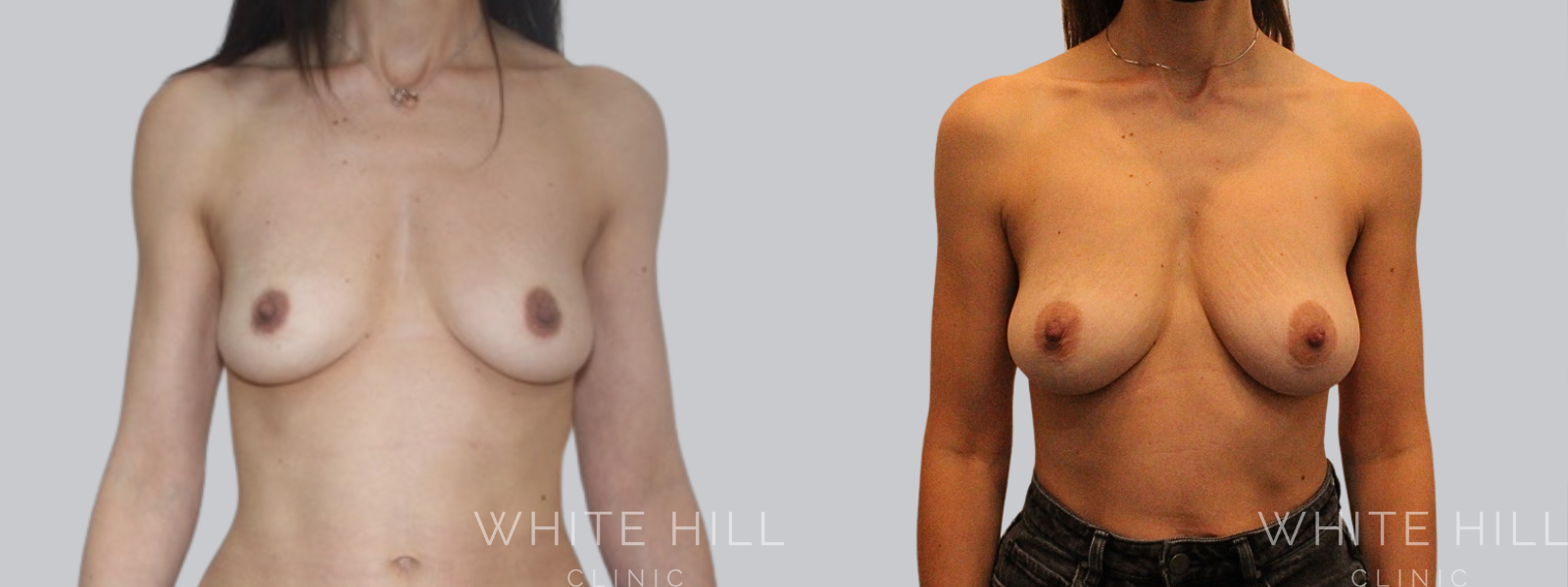 Patient Fat Transfer Breast Augmentation Before and After Sydney White Hill Clinic