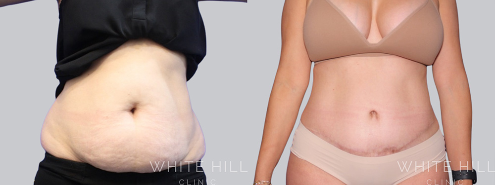 Abdominoplasty Surgery Sydney White Hill Clinic