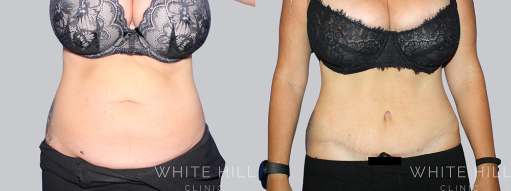 Abdominoplasty Surgery Sydney White Hill Clinic