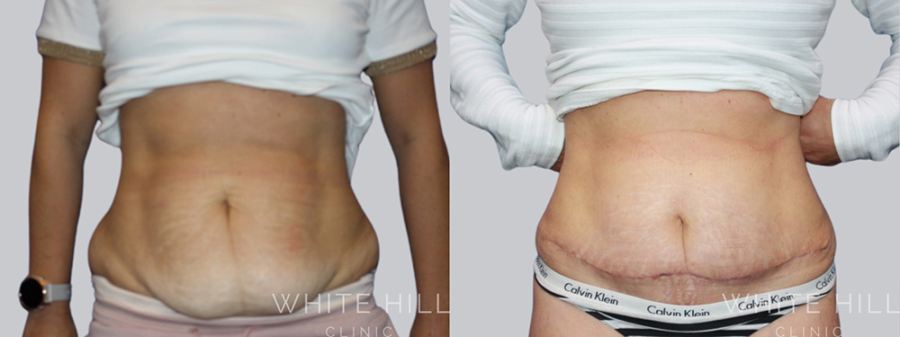 Abdominoplasty Surgery Sydney White Hill Clinic