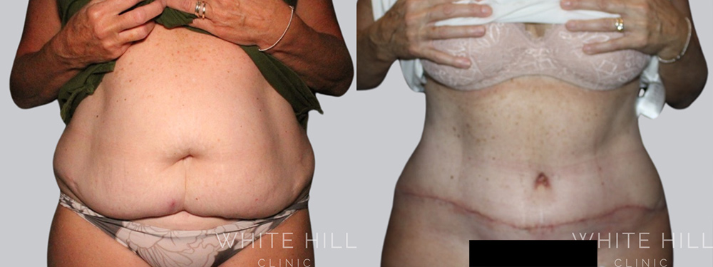 Abdominoplasty Surgery Sydney White Hill Clinic