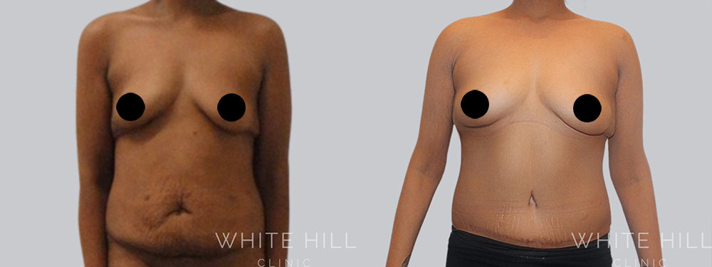 Abdominoplasty Surgery Sydney White Hill Clinic