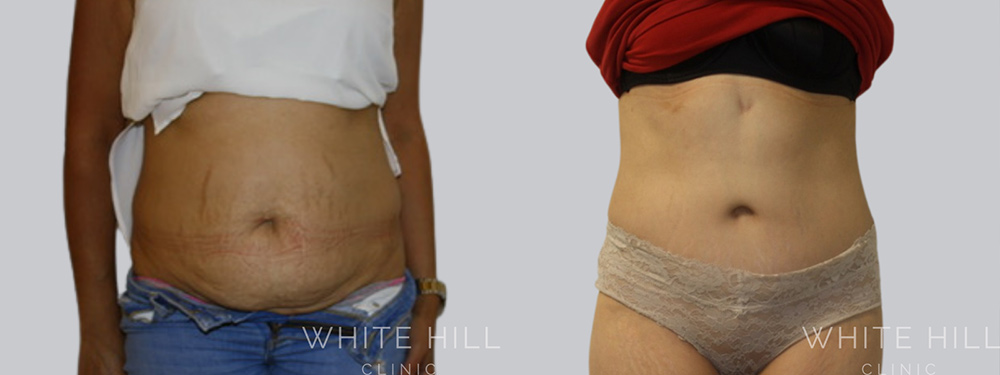 Abdominoplasty Surgery Sydney White Hill Clinic