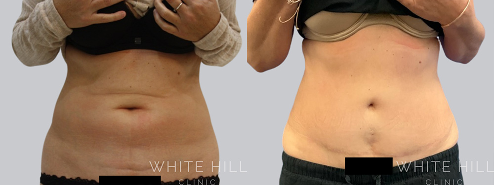 Abdominoplasty Surgery Sydney White Hill Clinic