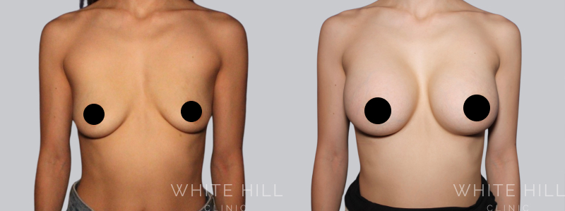 breast augmentation before after