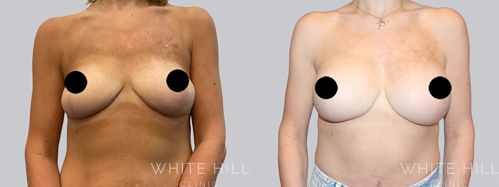 Breast Augmentation Surgery Sydney - White Hill Clinic