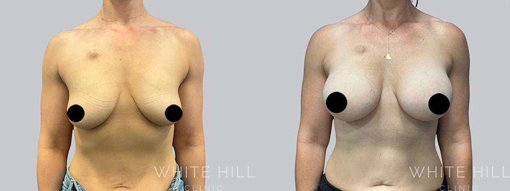 Breast Augmentation Surgery Sydney - White Hill Clinic