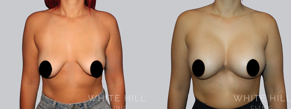 Breast Augmentation Surgery Sydney - White Hill Clinic