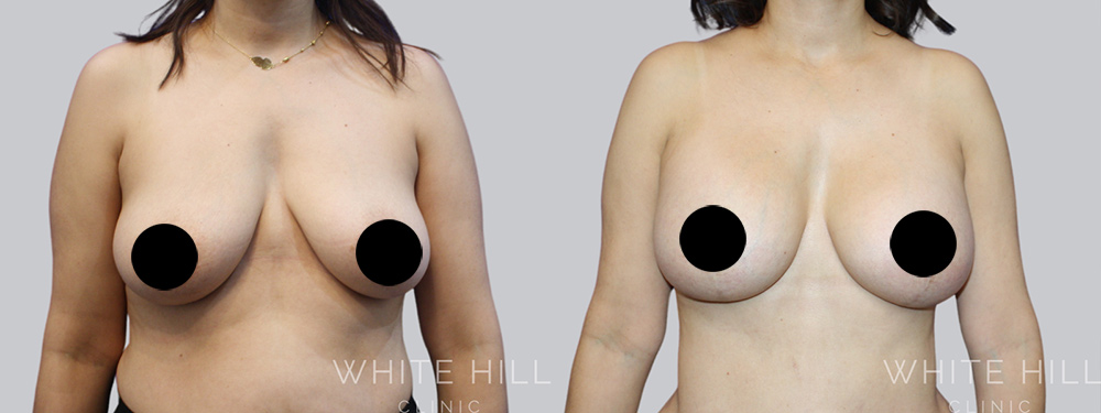 Breast Augmentation and Lift Before and After Surgery Sydney