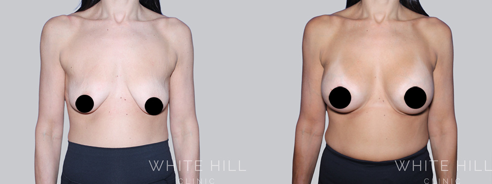 Breast Augmentation and Lift Before and After Surgery Sydney