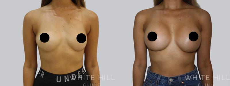 breast augmentation before after