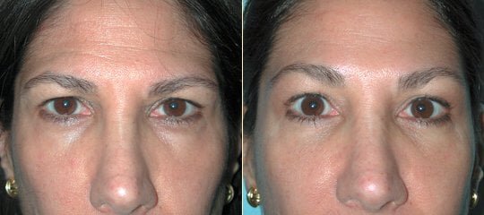 How Does A Brow Lift Work