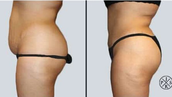 Everything You Need To Know About Abdominoplasty Surgery