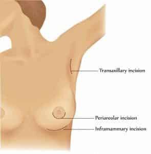 breast augmentation scars