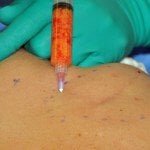 fat transfer breast scars