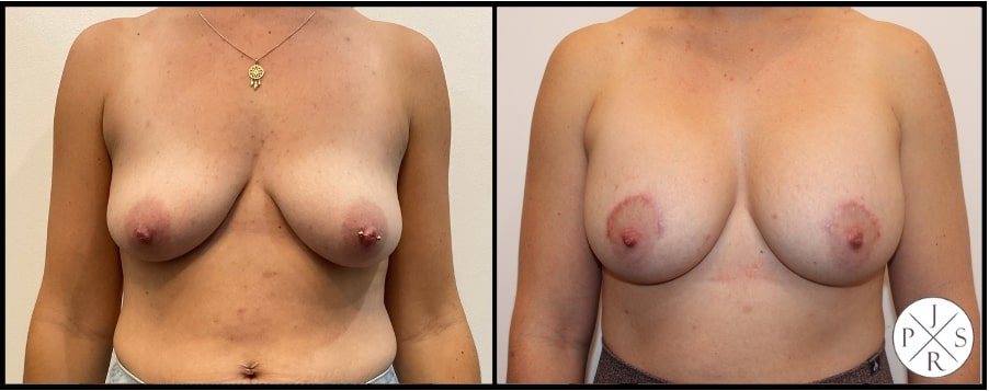 Breast Lift Before & Afters