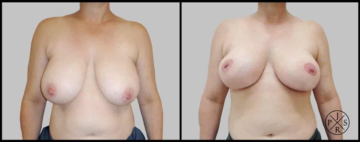 Breast Reduction Before After