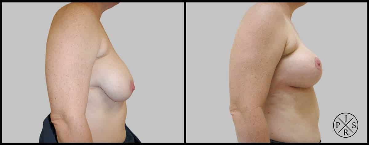 Breast Reduction Before After