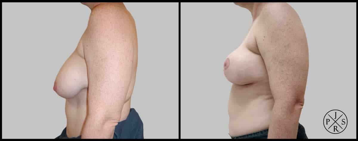 Breast Reduction Before After