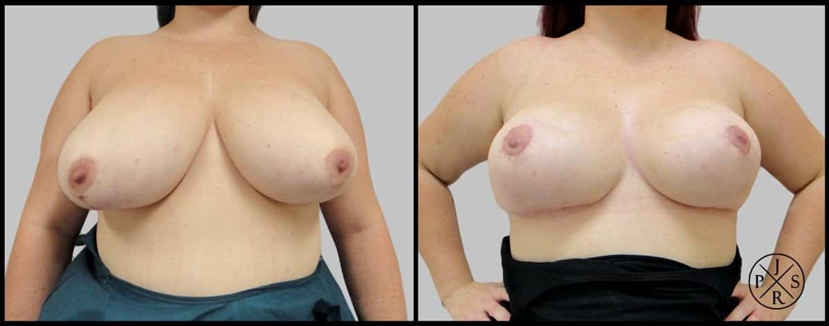 Breast Reduction Before After