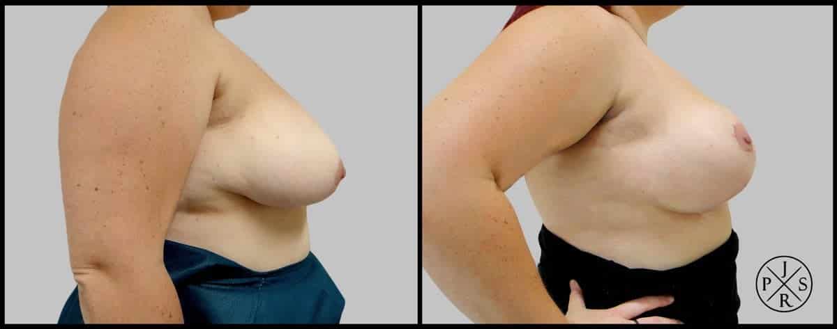 Breast Reduction Before After