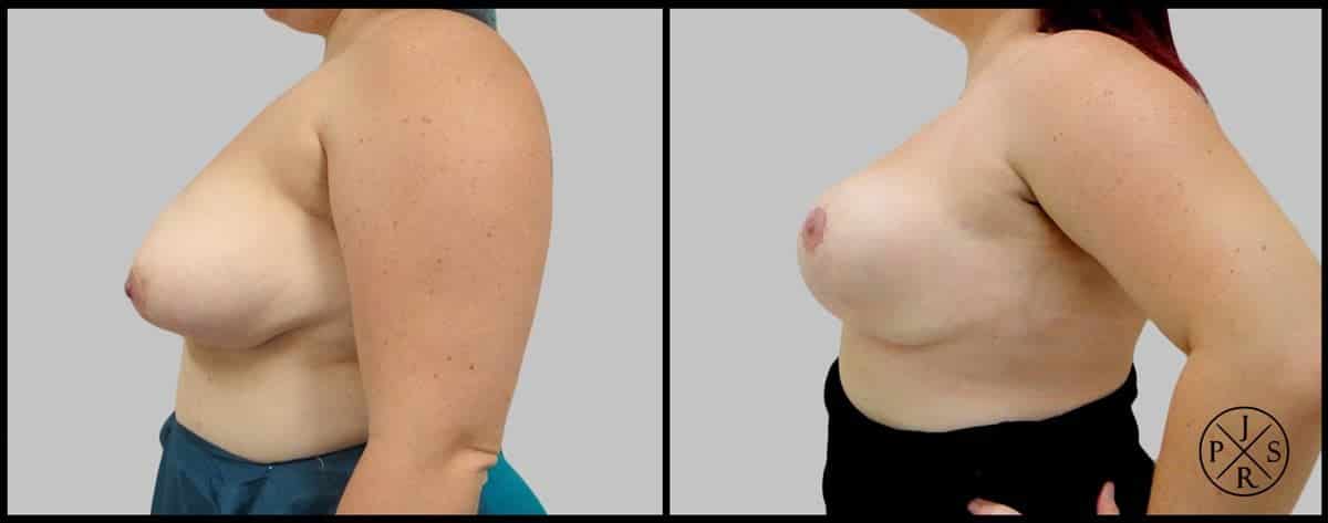 Breast Reduction Before After