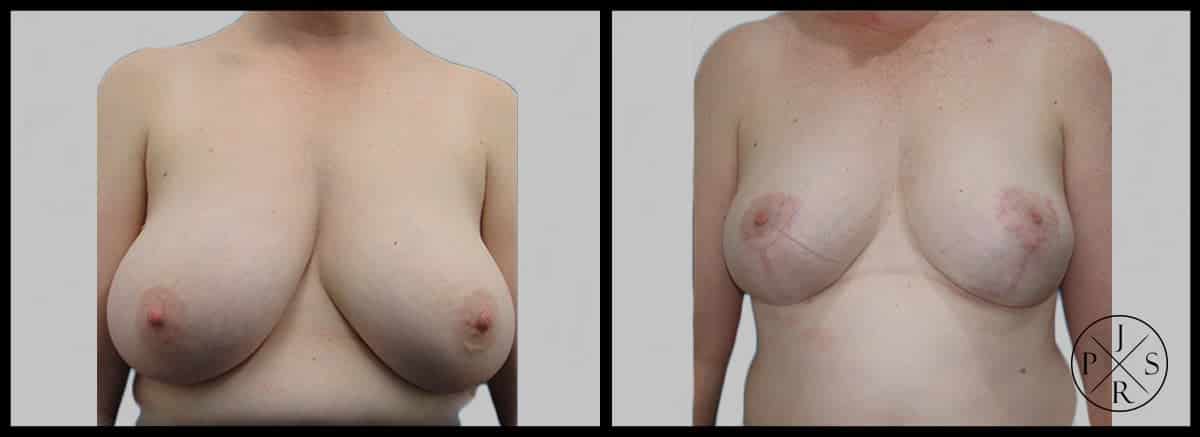 Breast Reduction Before After