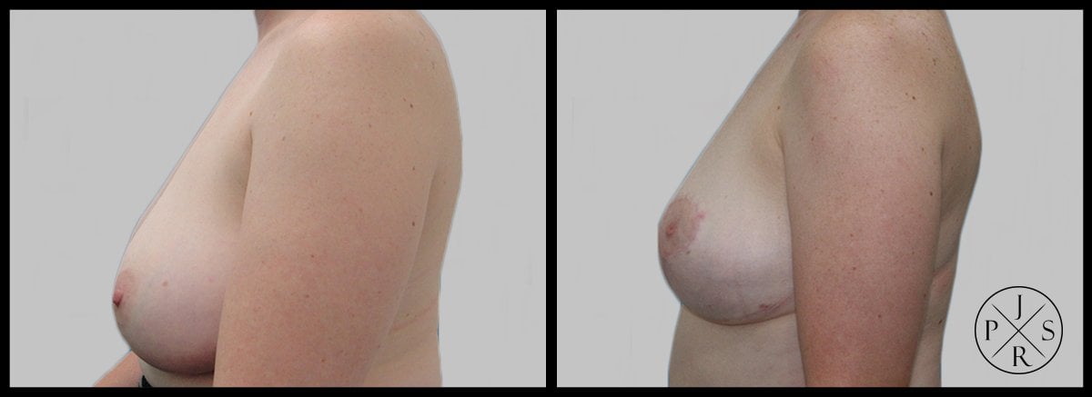 Breast Reduction Before After