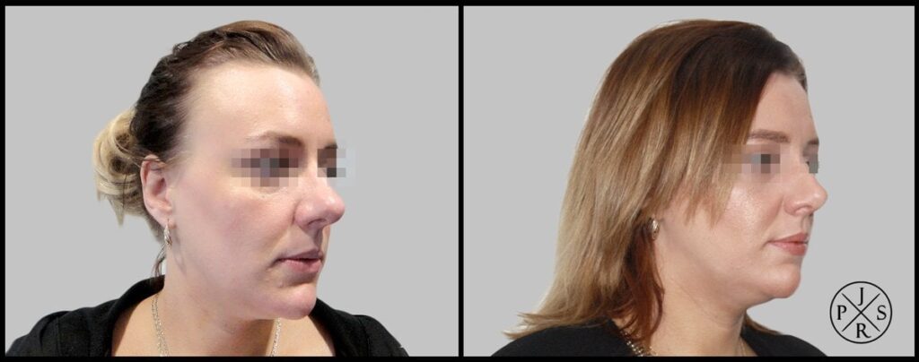 Rhinoplasty Before & Afters