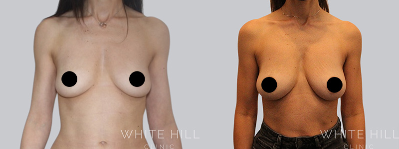 fat to breast augmentation before and after