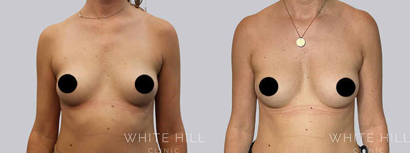 Fat to breast augmentation before and after