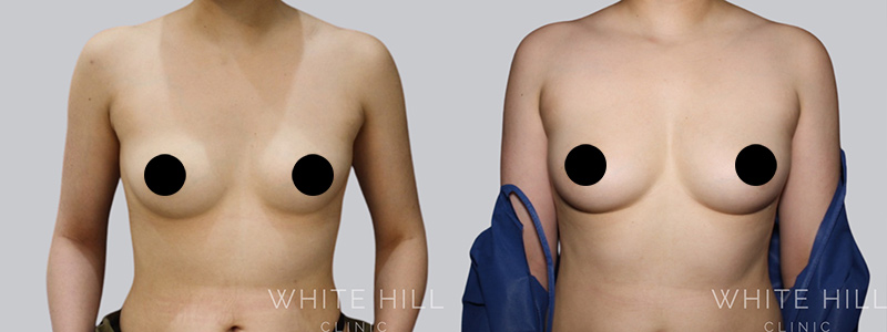 Fat to breast augmentation before and after