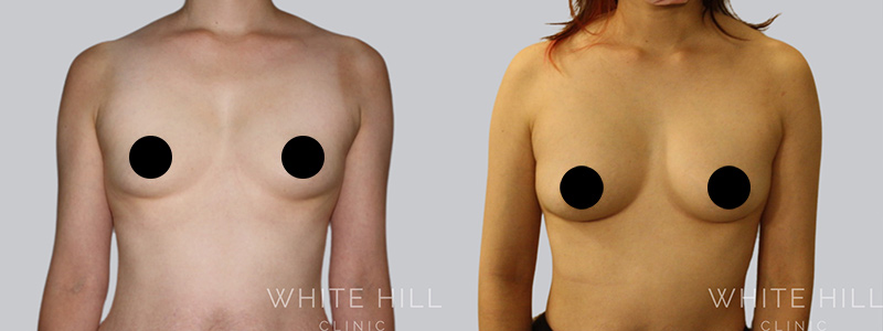 Breast Augmentation before after