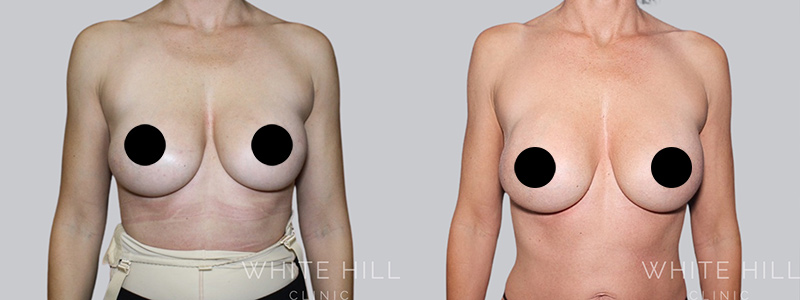 Fat to breast augmentation before and after