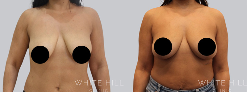 Fat to breast augmentation before and after