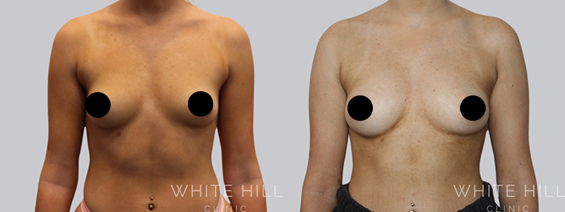 Fat to breast augmentation before and after