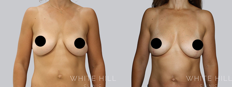 Fat to breast augmentation before and after