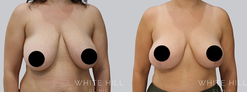 Breast Augmentation before after