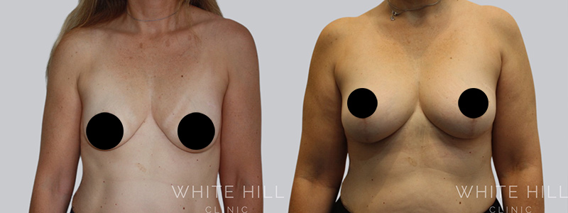 Fat to breast augmentation before and after