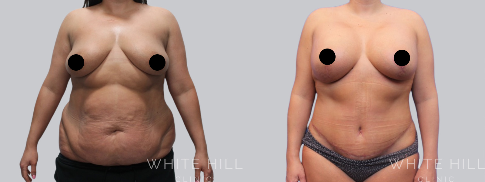 Abdominoplasty Sydney - White Hill Clinic