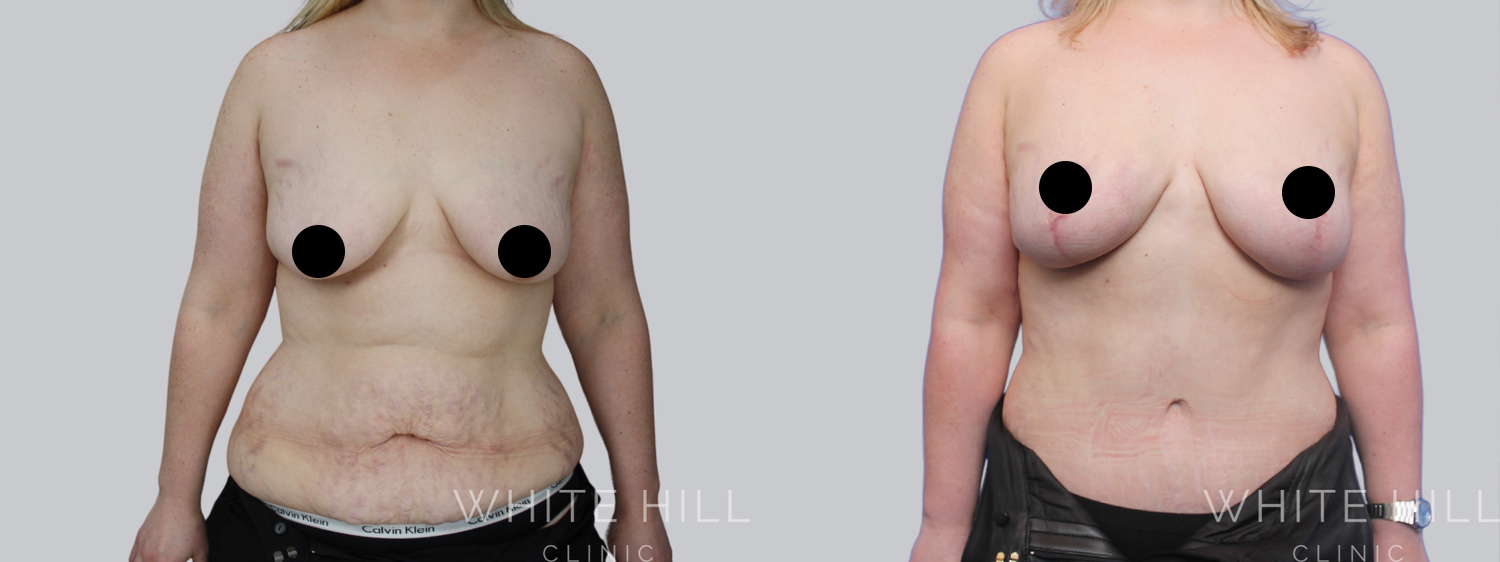 Abdominoplasty Sydney - White Hill Clinic