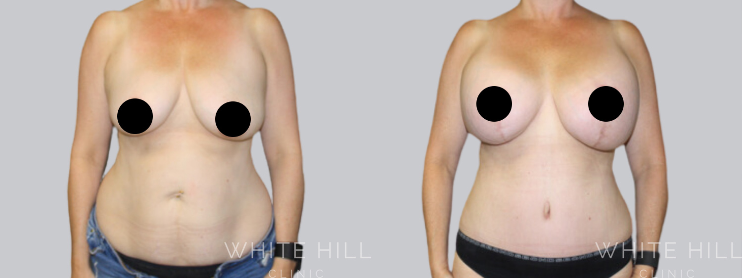 Abdominoplasty Sydney - White Hill Clinic