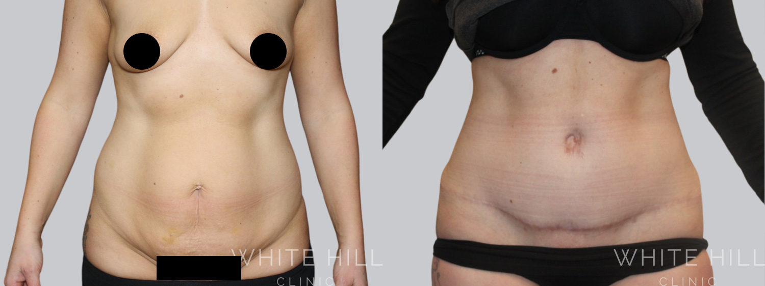 Abdominoplasty Sydney - White Hill Clinic