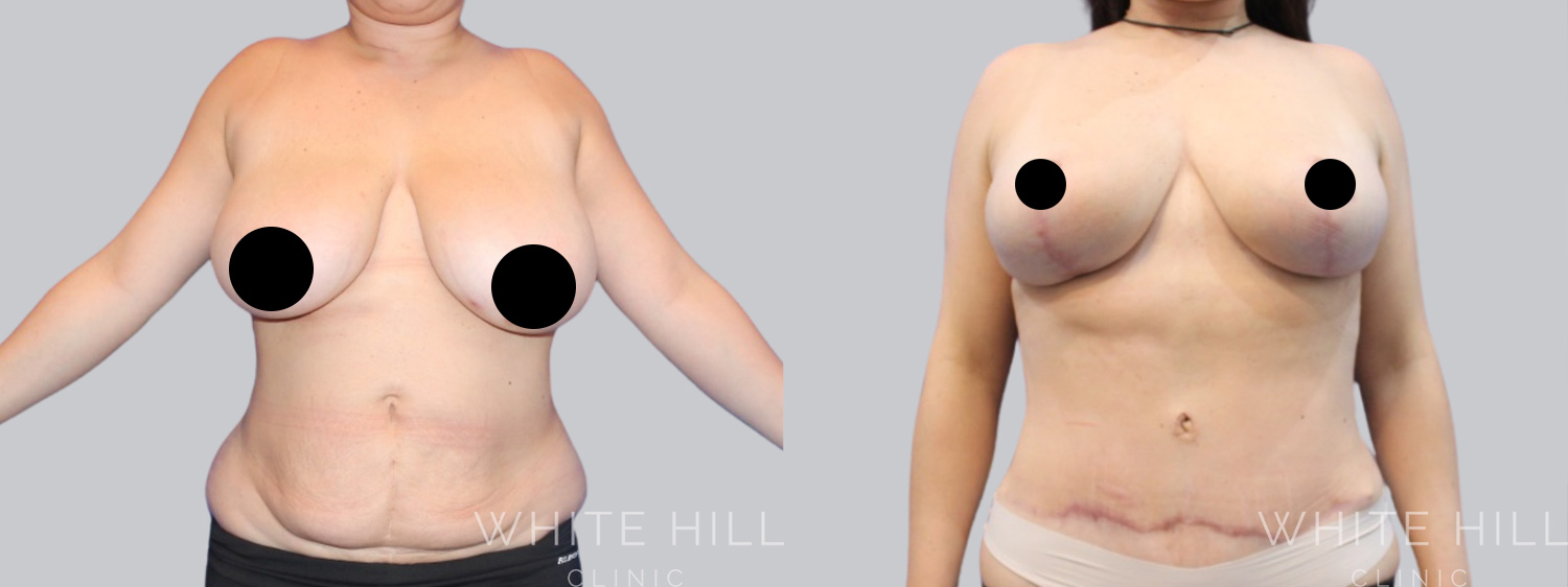 Abdominoplasty Sydney - White Hill Clinic