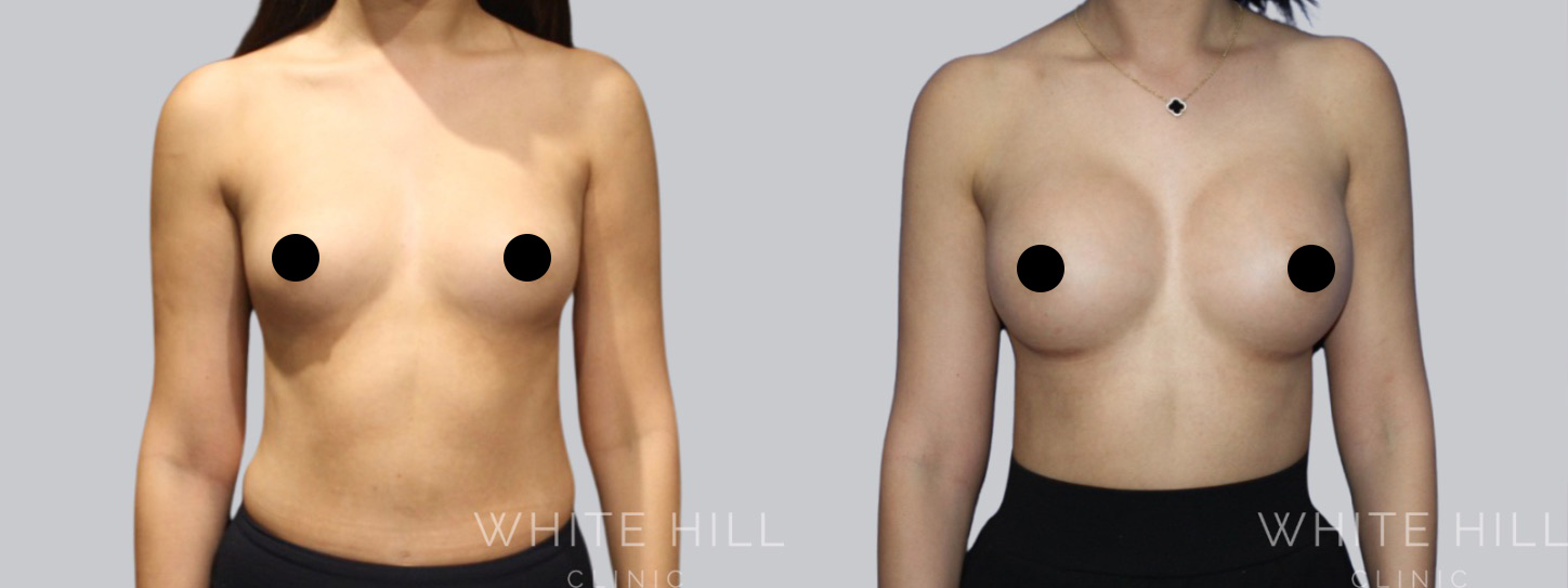 Breast Enhancement Sydney White Hill Clinic