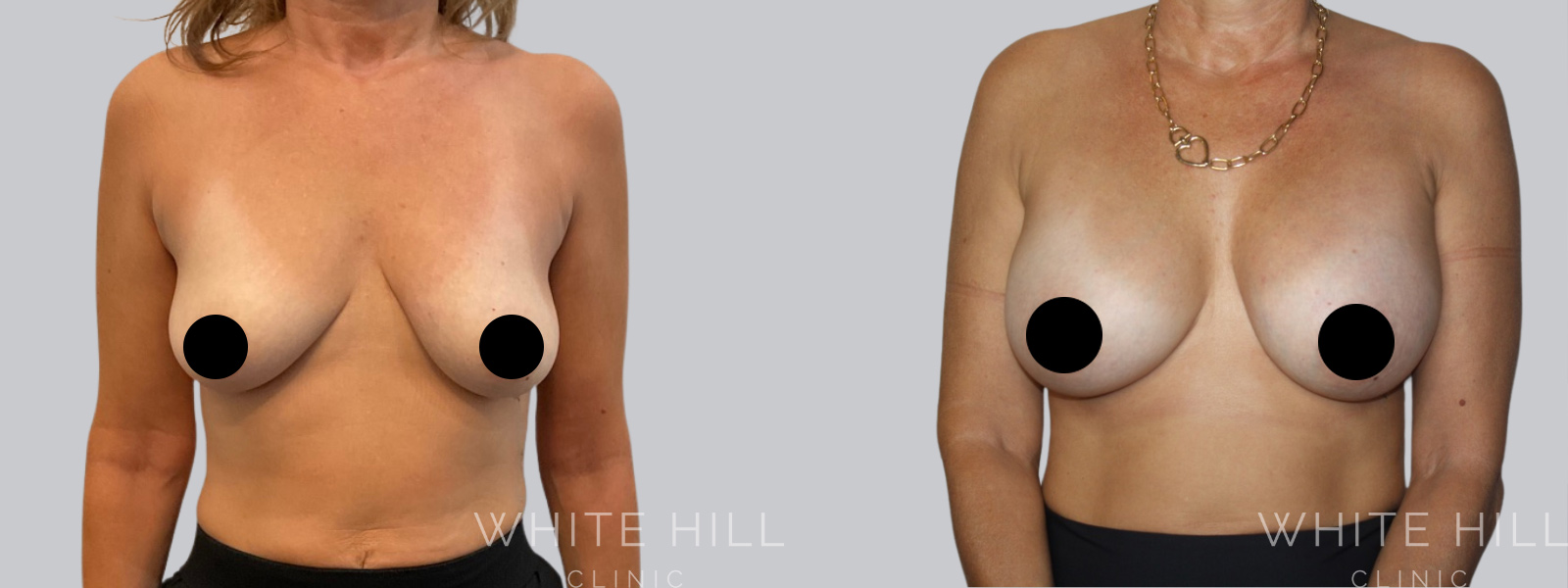 Breast Enhancement Sydney White Hill Clinic