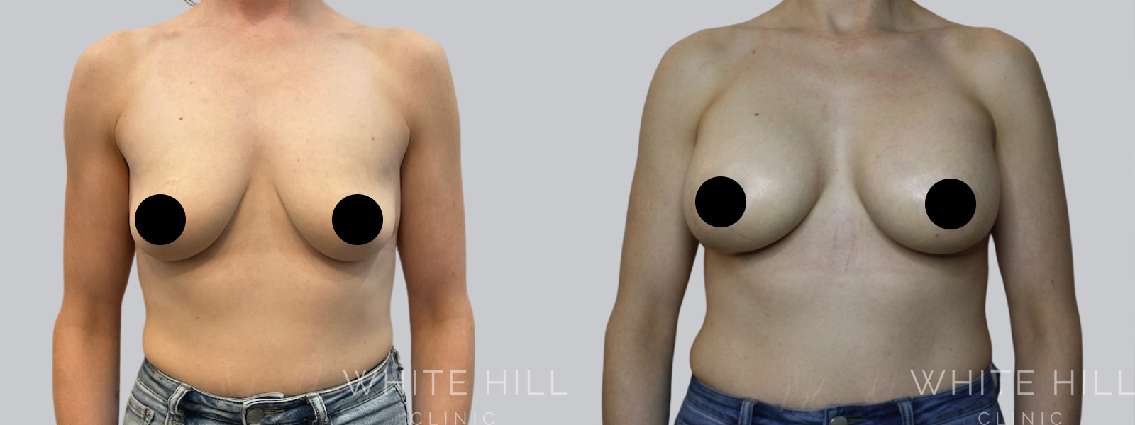 Breast Enhancement Sydney White Hill Clinic