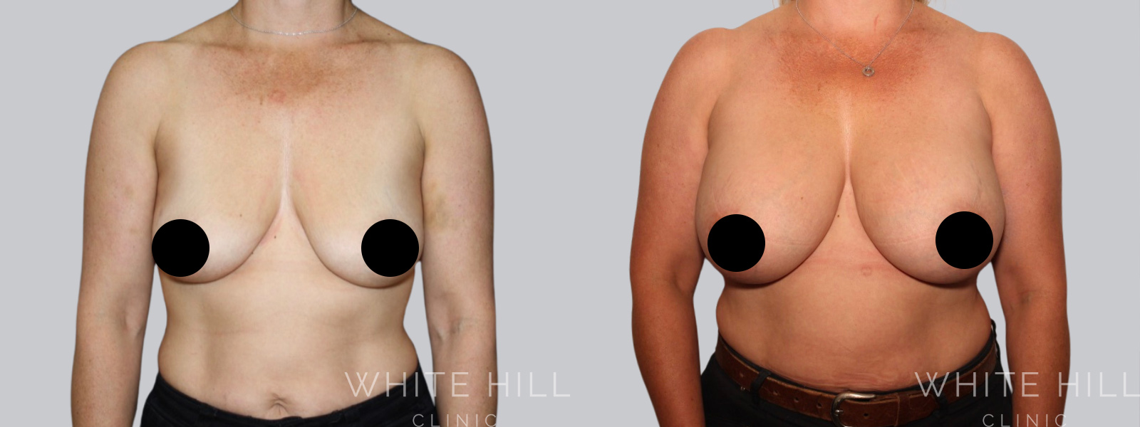 Breast Enhancement Sydney White Hill Clinic