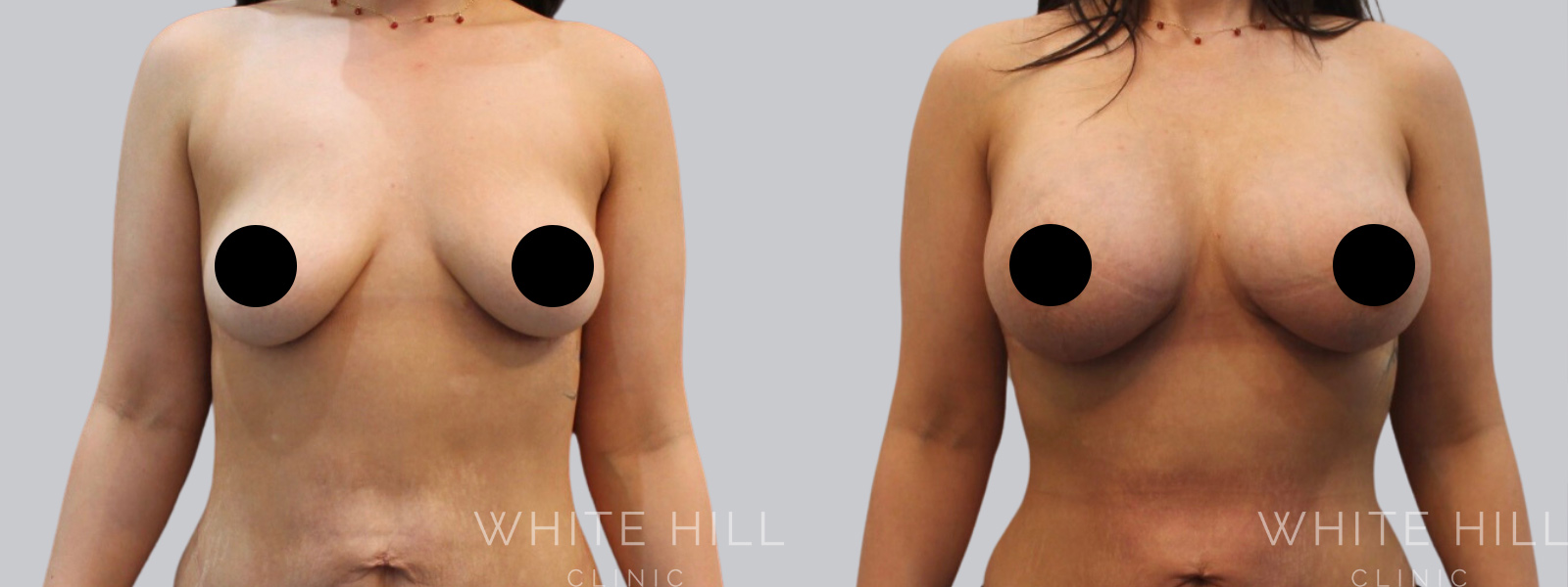 Breast Enhancement Sydney White Hill Clinic