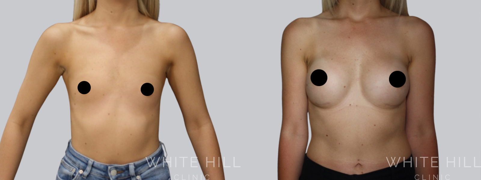 Breast Enhancement Sydney White Hill Clinic